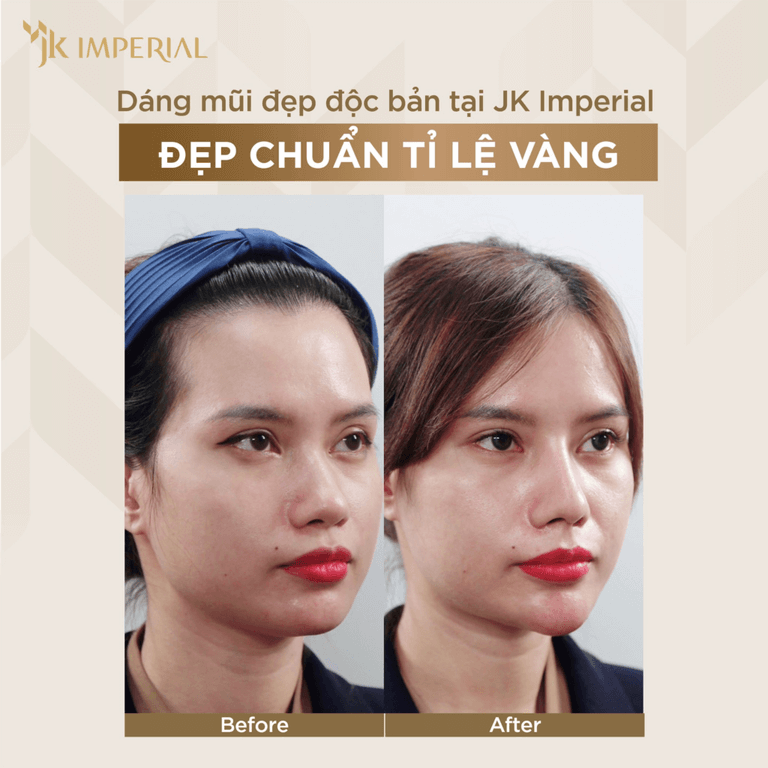 Kết quả thẩm mỹ mũi thực tế của khách hàng JK Imperial Việt Nam